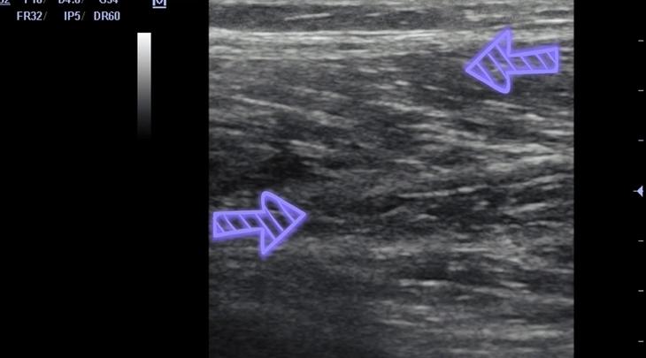 Injury Prevention with MSK Ultrasound