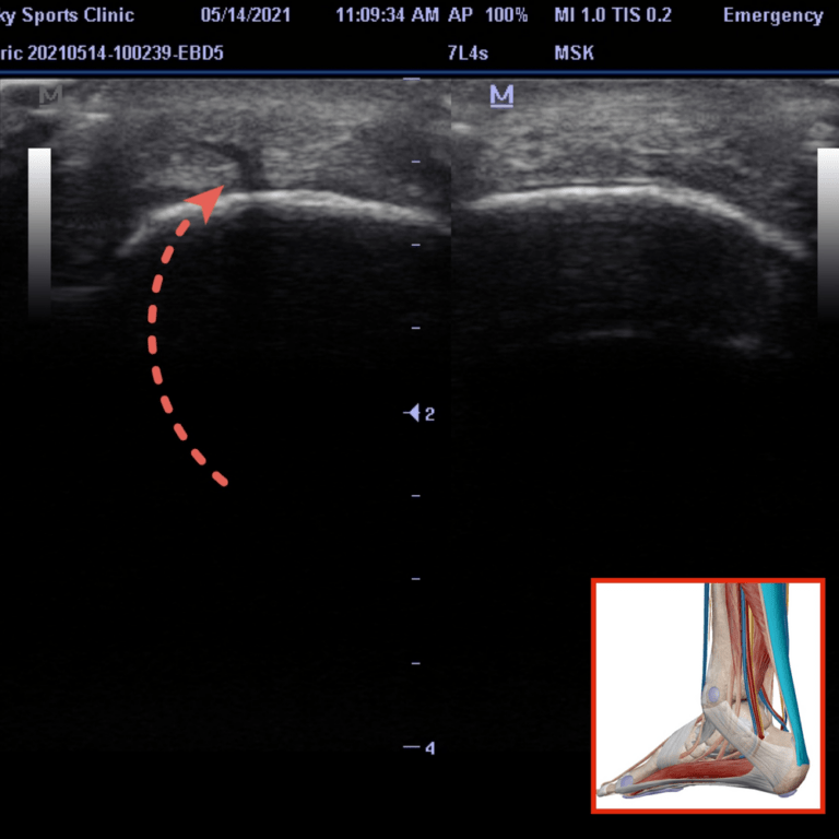 What Does An Achilles Tear Look Like?